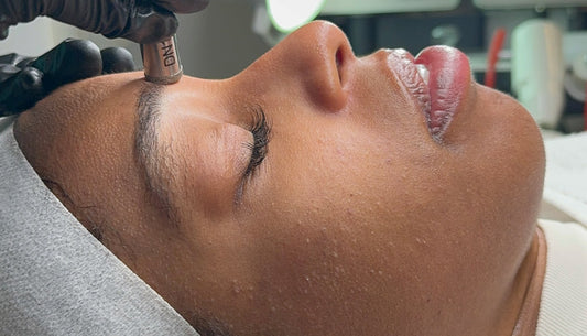 What is microneedling?