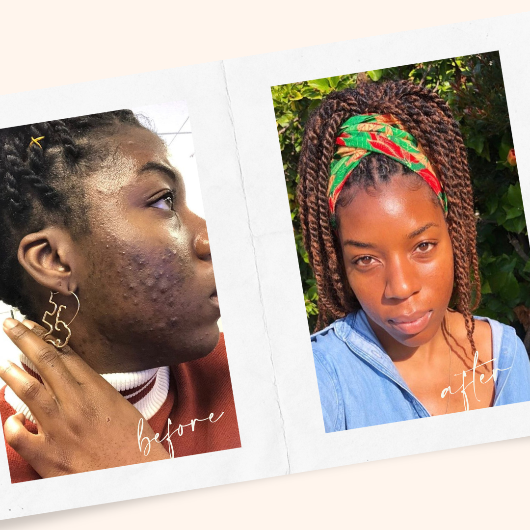Treating acne and hyperpigmentation for Black/BIPOC skin – Derm By Erica