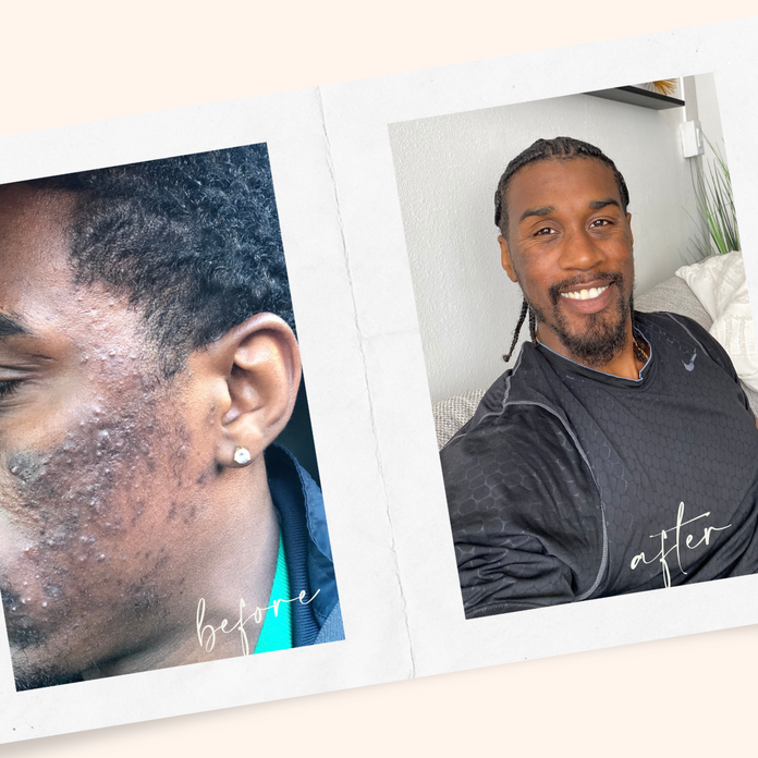 Treating acne and hyperpigmentation for Black/BIPOC skin – Derm By Erica