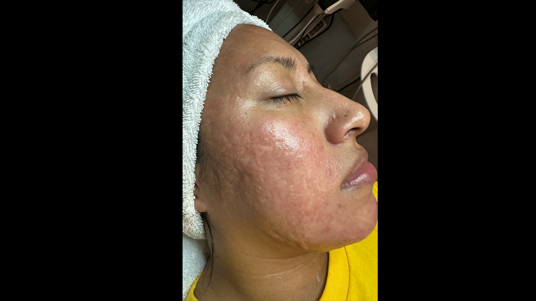 Body products treating acne and hyperpigmentation for melanated skin ...